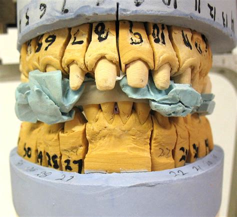 Bite Splint – FTI Dental Lab