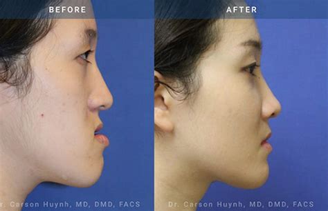 Orthognathic Surgery Atlanta Ga Radiance Surgery And Aesthetic Medicine