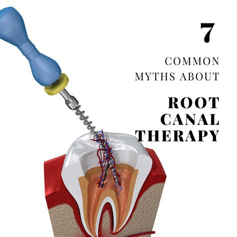 Common Myths About Root Canal Therapy Needham Bedford Franklin Ma