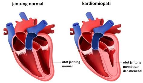 Apakah Kelainan Otot Jantung Bisa Sembuh Rs Pondok Indah