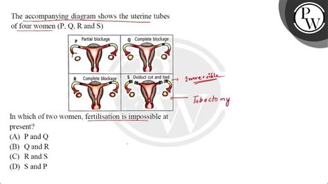 The Accompanying Diagram Shows The Uterine Tubes Of Four Women Youtube