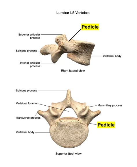 Pedicle Screws For Spinal Fusion Spine Info