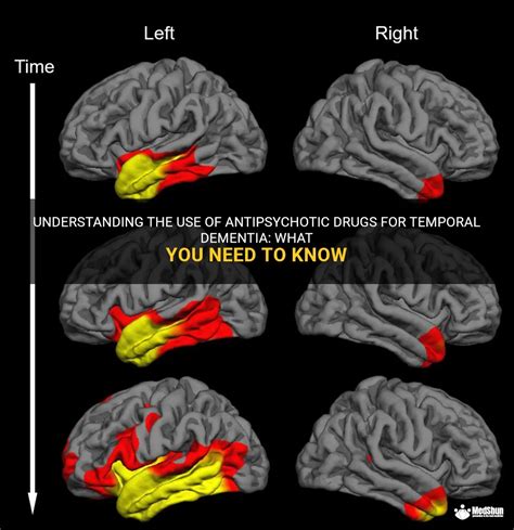 Understanding The Use Of Antipsychotic Drugs For Temporal Dementia