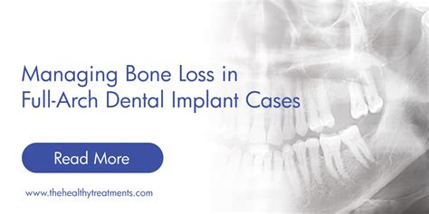 Managing Bone Loss in Full-Arch Dental Implant Cases - Elija un ...