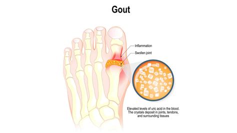 Anti Gout Drugs Solution Parmacy