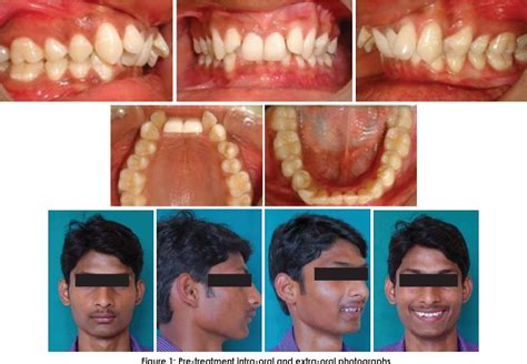 Figure 2 From Treatment Of Class II Div 2 Malocclusion Using PowerScope