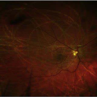 Case Color Fundus Photo Montage Of Left Eye A Showing