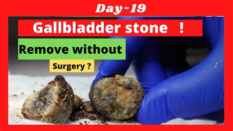 Can You Remove Gallbladder Stone Without Surgery Day 19 Youtube