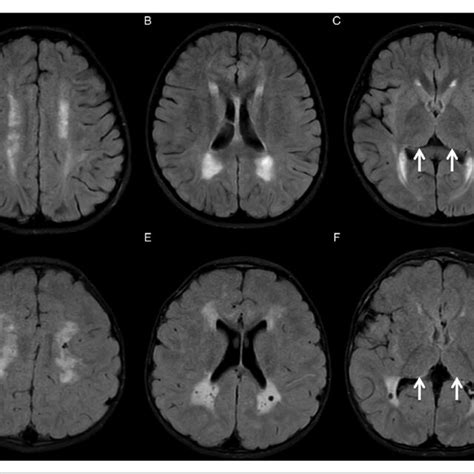 Neurometabolic Disorders With Profound Central Nervous System