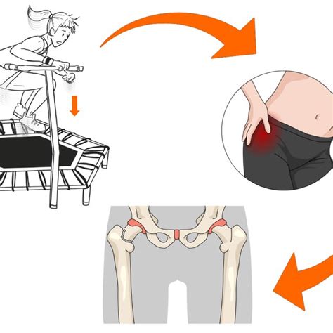 Schematic Animation Of Stress Fracture Of The Femoral Neck After