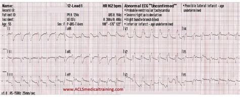 In Depth Wide Complex Tachycardia Acls Medical Training