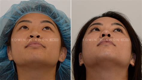 Alar Base Reduction Before Afters Edwin Kwon MD FACS