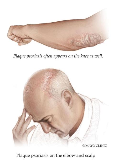 Mayo Clinic Minute Psoriasis Of The Scalp Mayo Clinic News Network