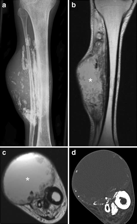 A Year Old Man With Calcific Myonecrosis Of The Anterior Compartment