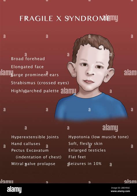 Fragile X Syndrome Chromosome Hi Res Stock Photography And Images Alamy