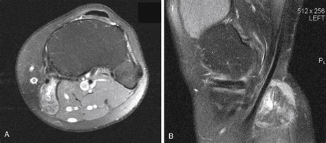 Approach To Pediatric Soft Tissue Masses Radiology Key