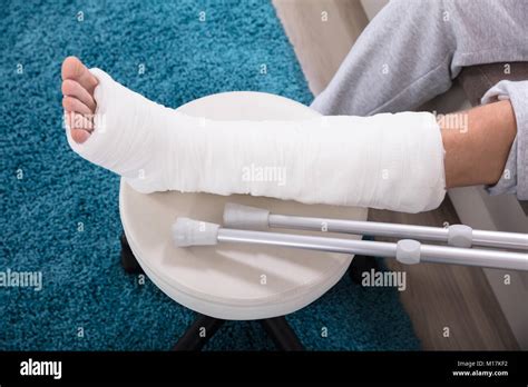 Broken Leg Cast High Resolution Stock Photography And Images Alamy