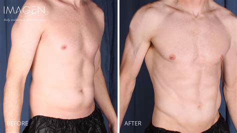 4D Hi Definition Lipo Omaha Liposuction By Imagen