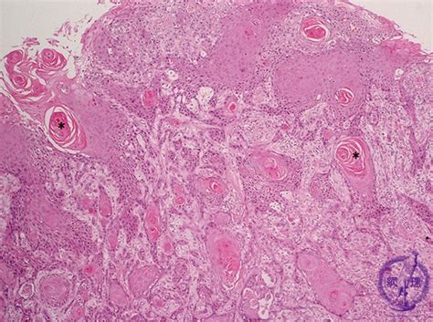 7oral Salivary Gland 6 Oral Cancer Squamous Cell Carcinoma