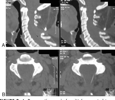 Figure 2 from Cervical Meningocele Causing Symptoms in Adulthood ...