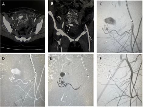 Figure 1 From Transarterial Embolization Of Acquired Uterine Artery