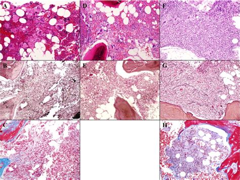 Histological Findings Of Bone Marrow Biopsies A The First Bone