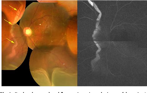 Figure 1 From Retinal Detachment With Retinal Pigment Epithelial Tear