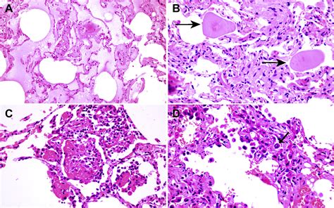 Pulmonary Pathology Of Early Phase 2019 Novel Coronavirus COVID 19