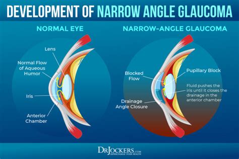 Glaucoma Symptoms Causes And Natural Support Strategies