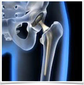 Stryker V40 hip replacement implants update: settlement reached in hip ...