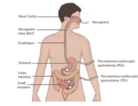 S Enteral Tubes Flashcards Quizlet