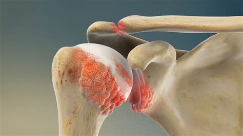 AC joint Arthritis Treatment in Pune, India | Best Acromioclavicular Joint Repair Doctors in Pune