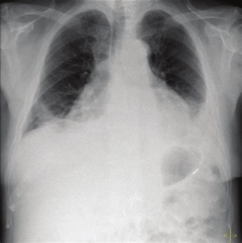 Pleural Effusion On X Ray