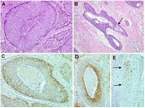 A Basaloid Nests Displaying Central Necrosis Without Keratinization B