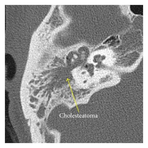 Cholesteatoma Can Be Easily Overlooked When Hidden Over The Outer Attic Download Scientific