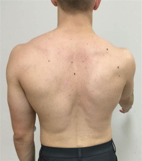 Superior Angle Of Scapula Palpation