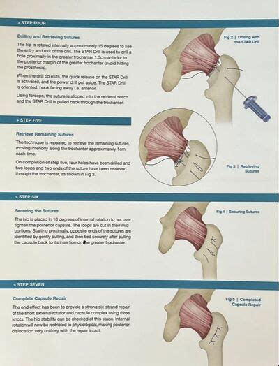 STAR Drill - Burn Orthopaedics - BURN ORTHOPAEDICS