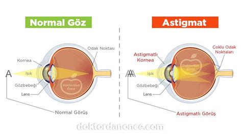 Astigmat Nedir Nedenleri ve Belirtileri Doktordan Önce