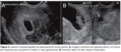 Scielo Brasil Anormalidades Do Primeiro Trimestre Da Gravidez