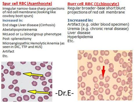 مدونة معملي للتحاليل الطبية والاختبارات المعمليه: Acanthocytes تشوهات ...