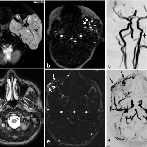 Mri Demonstrates The Typical Features Of Common Vascular Anomalies