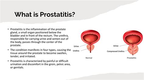 PPT Prostatitis Symptoms Causes Treatment Guide PowerPoint