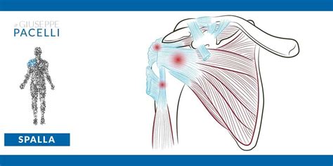 Calcificazione Spalla I Sintomi Le Fasi E I Rimedi Al Dolore
