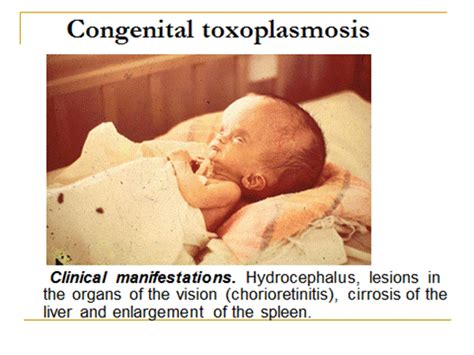 Congenital Toxoplasmosis