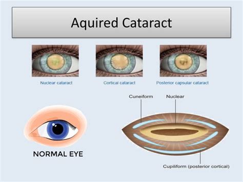 Types Of Cataract | PPT