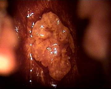 Atlas de colposcopie Docteur Benchimol Gynécologue obstétricien à