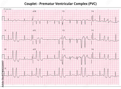 Couplet Premature Ventricular Complex PVC Ventricular Premature