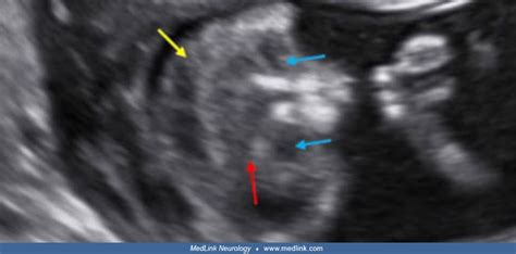 Anencephaly And Other Neural Tube Defects Medlink Neurology