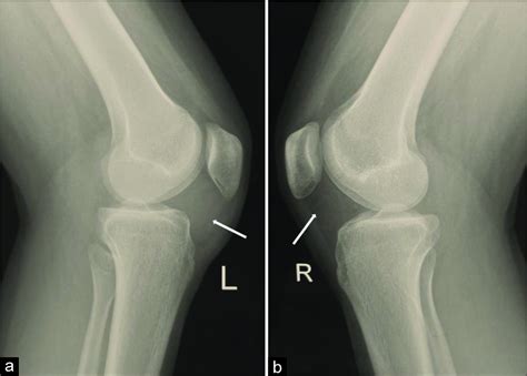 A Case Report Of Synovial Hemangioma A Rare Cause Of Opacity In Hoffa