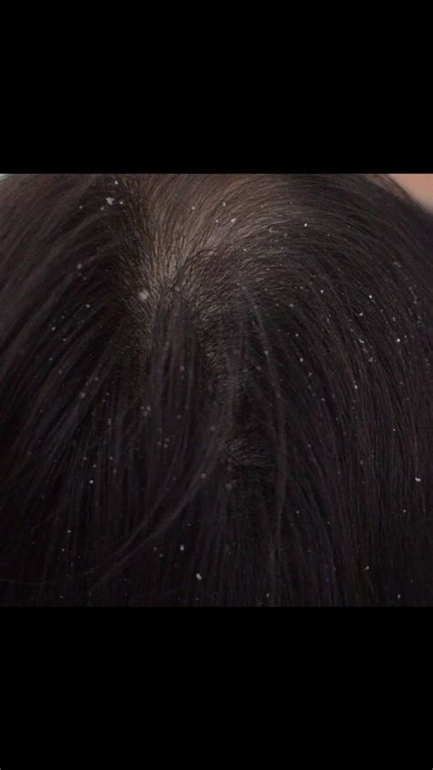 Relaxing scalp check dandruff relaxing – Artofit